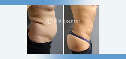 vaser liposuction turkey before after