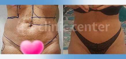 vaser liposuction turkey before after