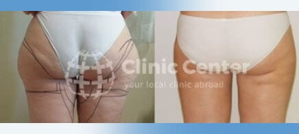 vaser liposuction turkey before after