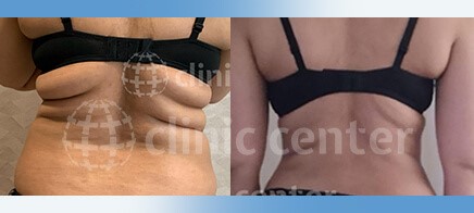 vaser liposuction turkey before after