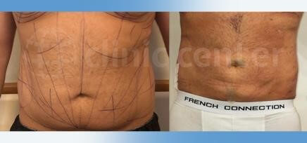 vaser liposuction turkey before after