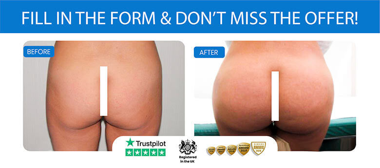 Get The Perfect Shaped Butts With BBL (Brazilian Butt Lift