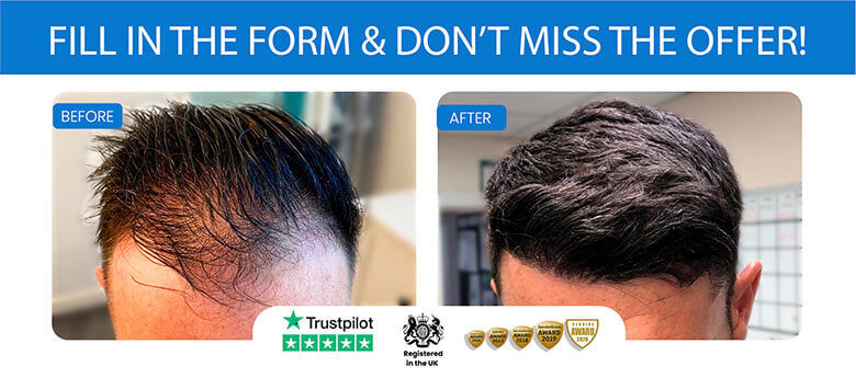 How Much Is A Hair Transplant In Turkey Uk