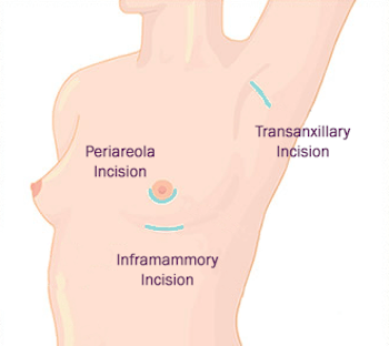 Boob Job Turkey Breast Augmentation Implants in Turkey