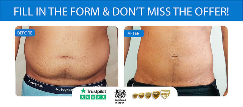 Lipo Scars? Book your consultation online. Don't want to pay full