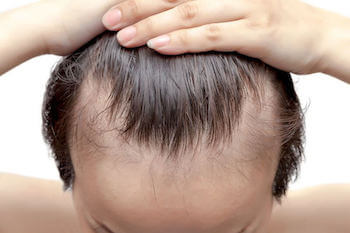 Anemia and Hair Loss | Blog | Clinic Center