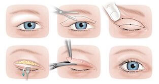 How much does blepharoplasty cost in Canada?