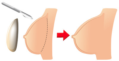 Types of Boob