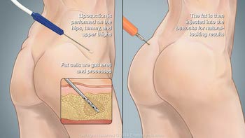 A Comprehensive History of the Brazilian Butt Lift - Premier Plastic Surgery