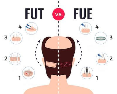 Hair Transplant in Turkey FUT vs FUE