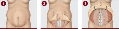 tummy tuck turkey