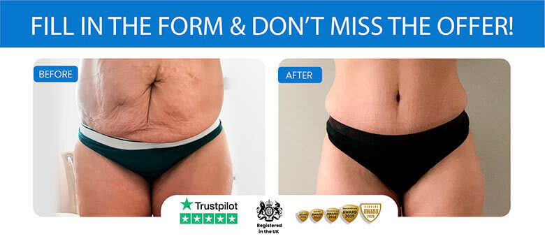 Tummy Tuck Before After - Aydin Center for Plastic Surgery