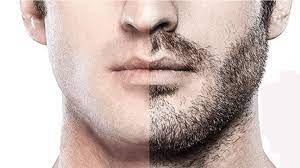 Beard Transplant: Who Had It Done?