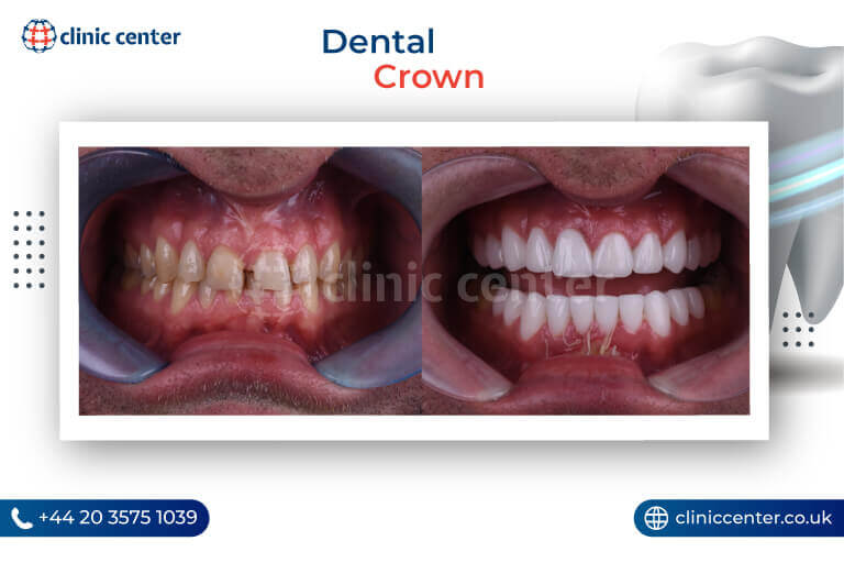 Dental Crowns Turkey Before After