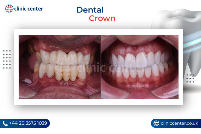 Dental Crowns Turkey Before After