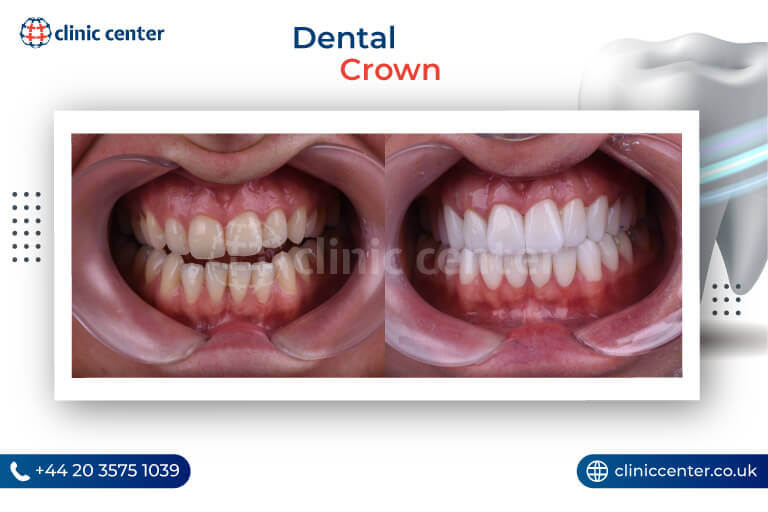 Dental Crowns Turkey Before After