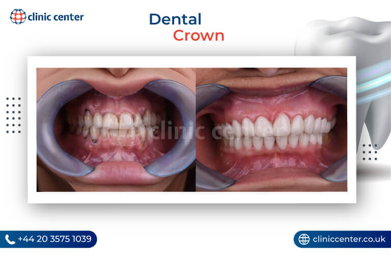 Dental Crowns Turkey Before After