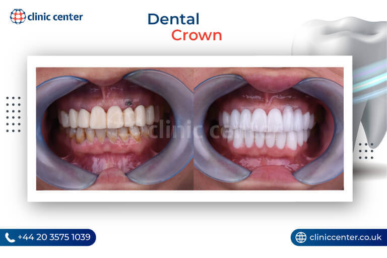 Dental Crowns Turkey Before After