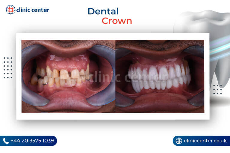 Dental Crowns Turkey Before After