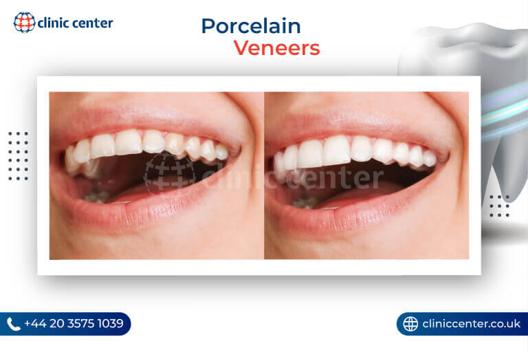 Porcelain Veneers Turkey Before After