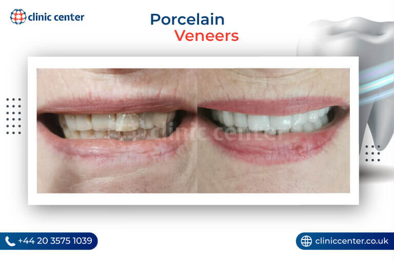 Porcelain Veneers Turkey Before After