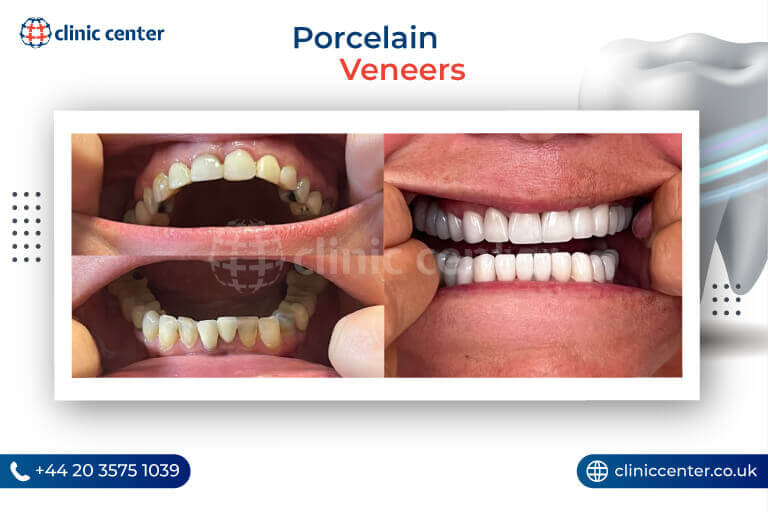 Porcelain Veneers Turkey Before After