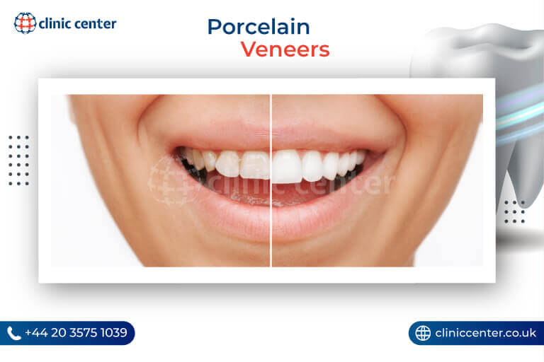 Porcelain Veneers Turkey Before After