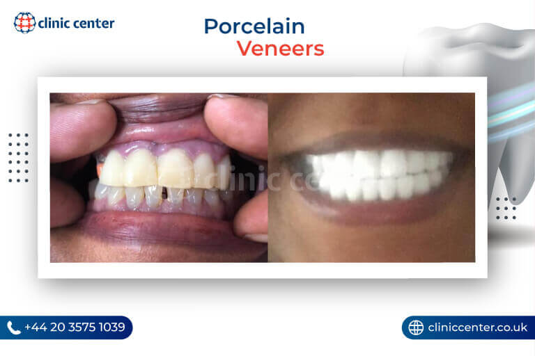 Porcelain Veneers Turkey Before After