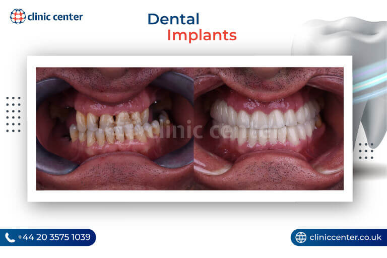 Dental Implants in Turkey