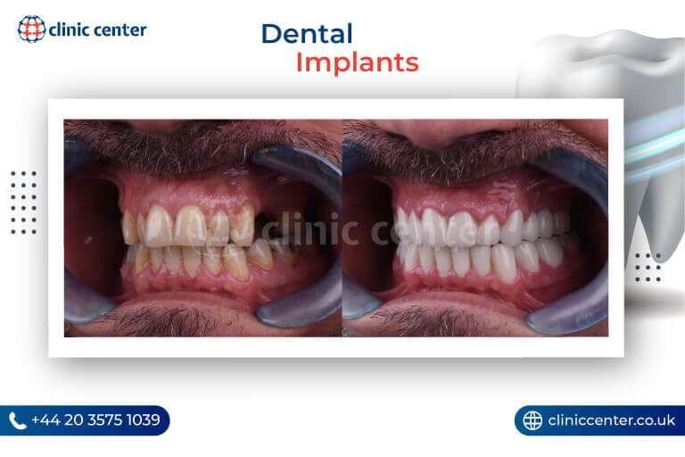 Dental Implants in Turkey