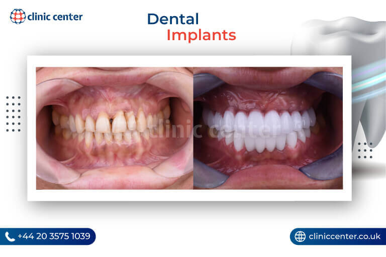 Dental Implants in Turkey