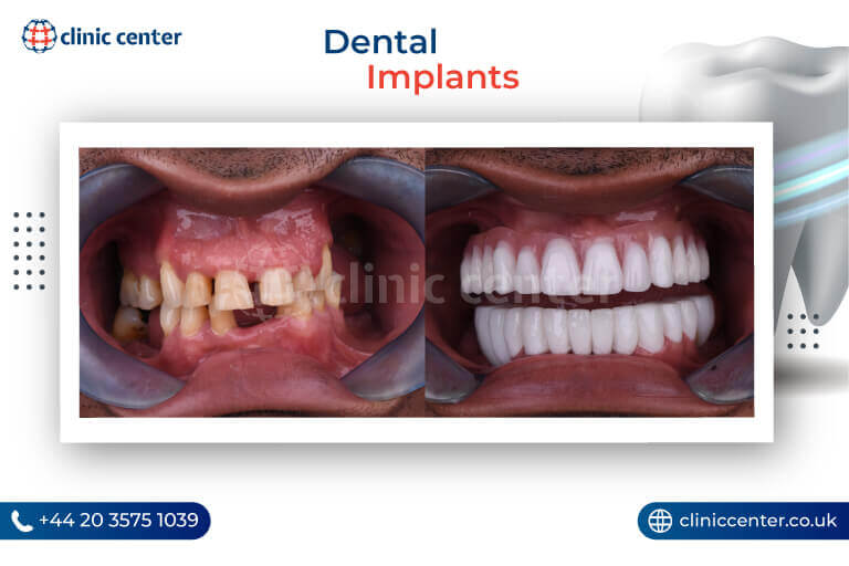 Dental Implants in Turkey