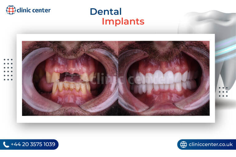 Dental Implants in Turkey