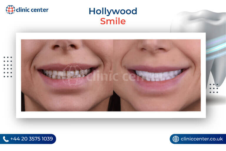 Hollywood Smile Turkey Before After