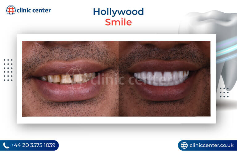 Hollywood Smile Turkey Before After