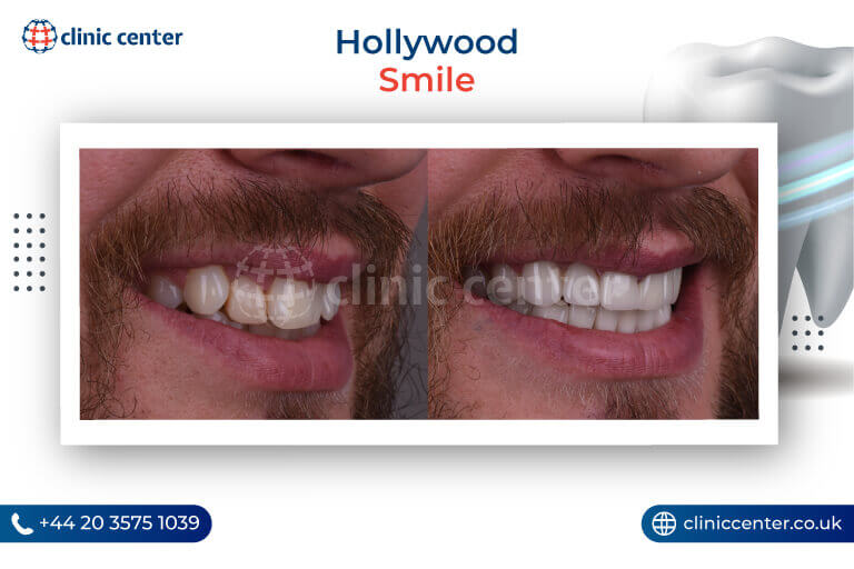 Hollywood Smile Turkey Before After