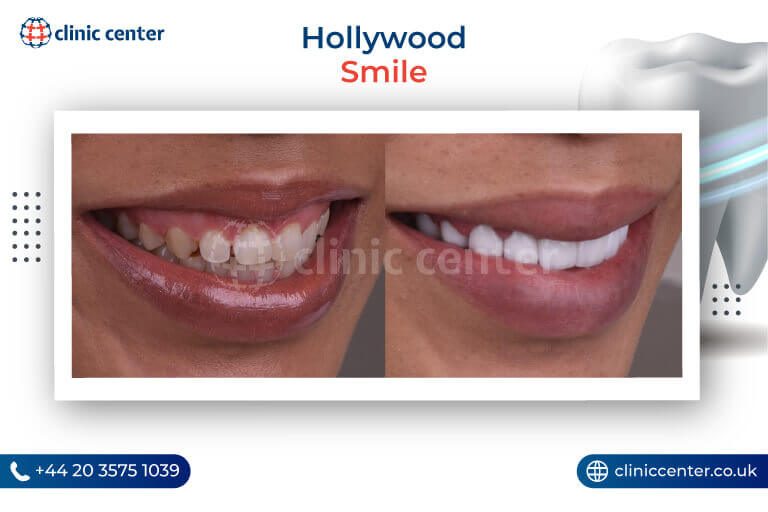 Hollywood Smile Turkey Before After