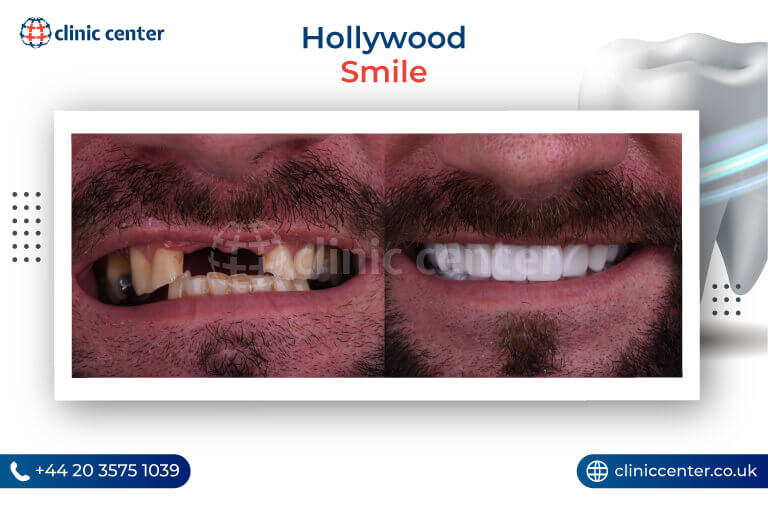 Hollywood Smile Turkey Before After