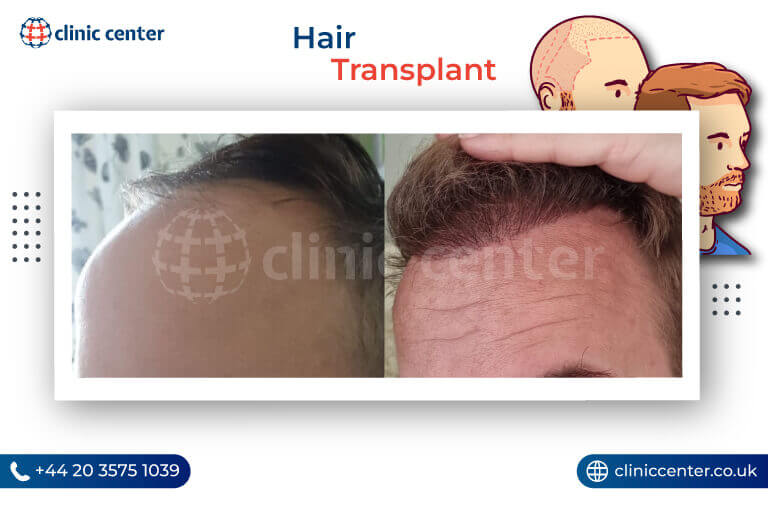 Hair Transplant in Turkey Before After