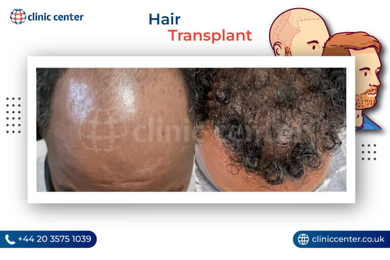 Hair Transplant in Turkey Before After