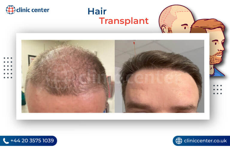 Hair Transplant in Turkey Before After