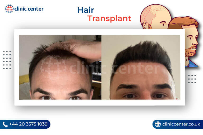 Hair Transplant in Turkey Before After