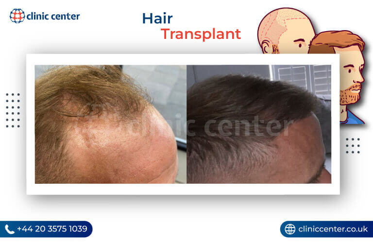 Hair Transplant Cost Explained and Compared to Save you Money