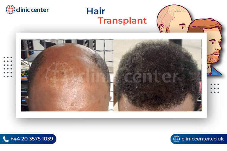 Hair Transplant in Turkey Before After