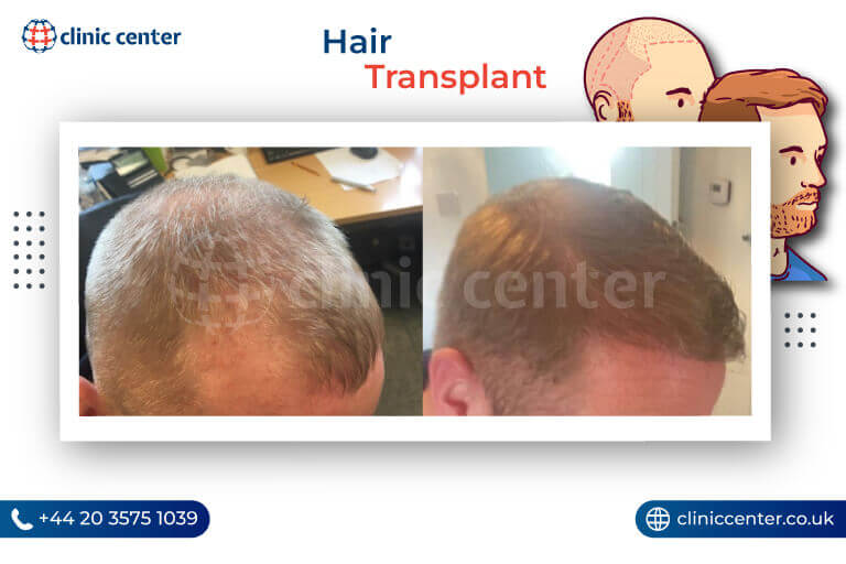 Hair Transplant in Turkey Before After