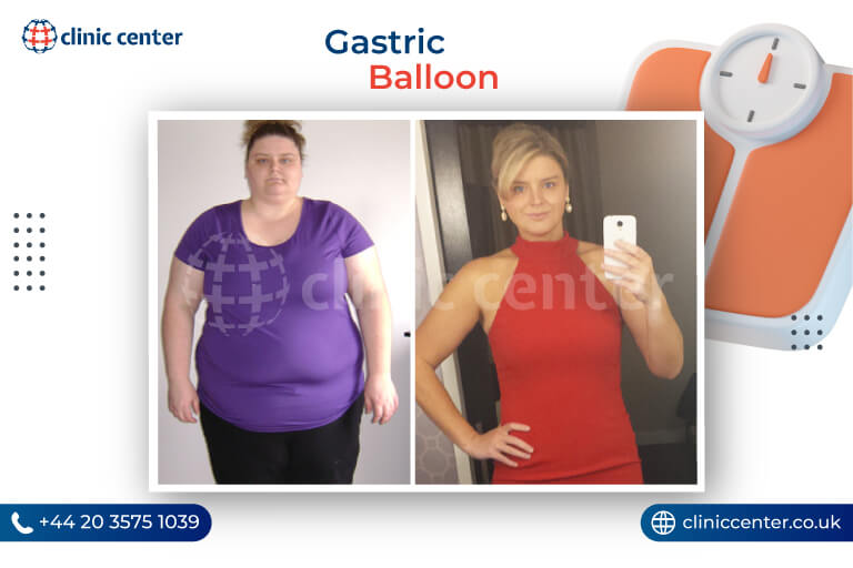 Gastric Balloon Turkey Before After