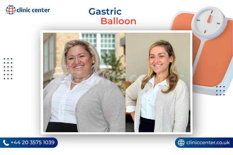 Gastric Balloon Turkey Before After