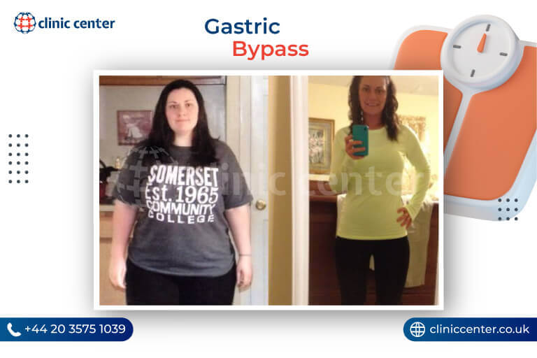 Gastric Bypass in Turkey Before After