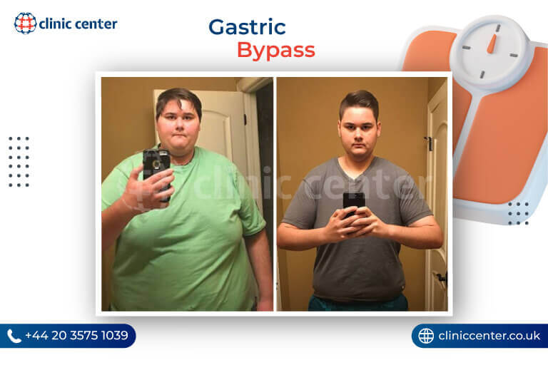 Gastric Bypass in Turkey Before After