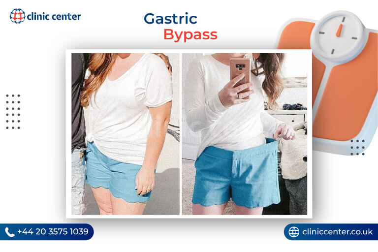 Gastric Bypass in Turkey Before After